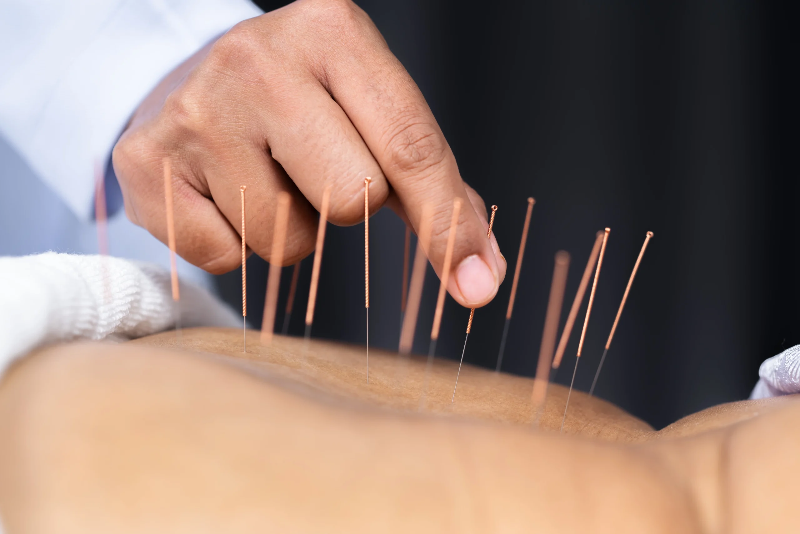 4-Treatment Package – $90; acupuncturist placing thin acupuncture needles into a patient's back during a professional wellness session.